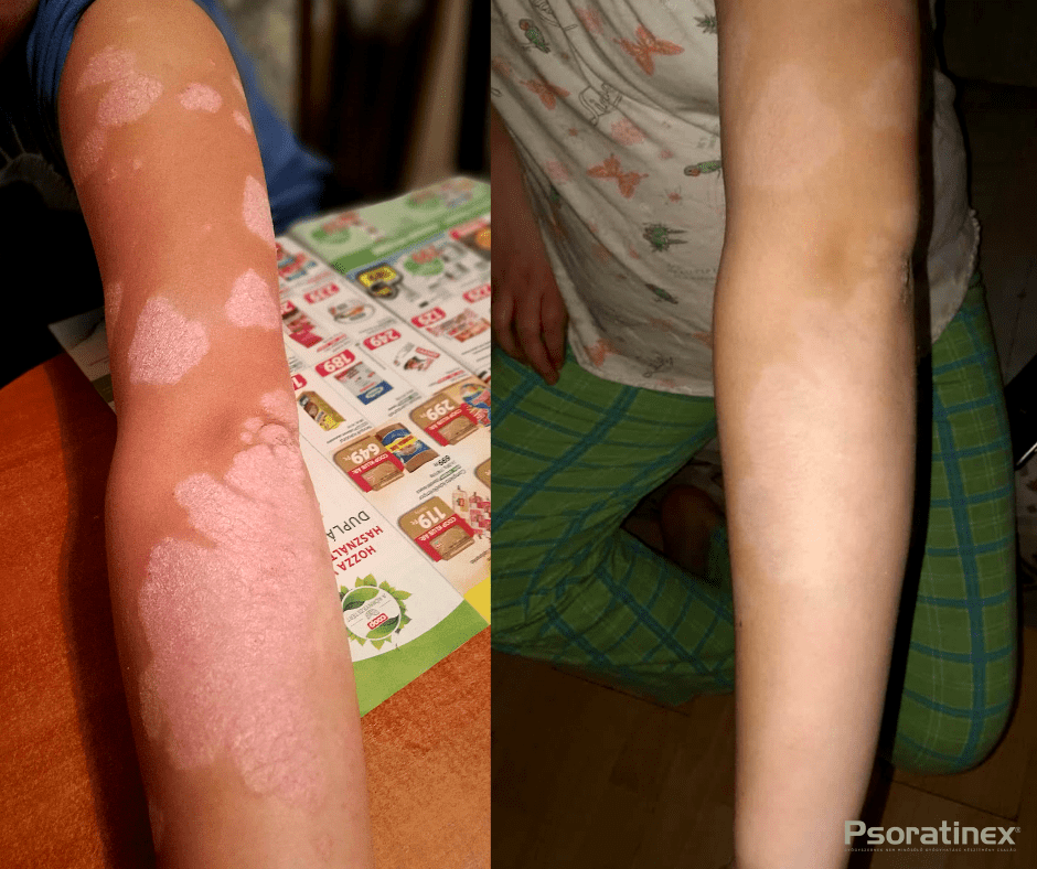 pikkelysömör kezelésének története bőrbetegségek vörös foltok a kezeken